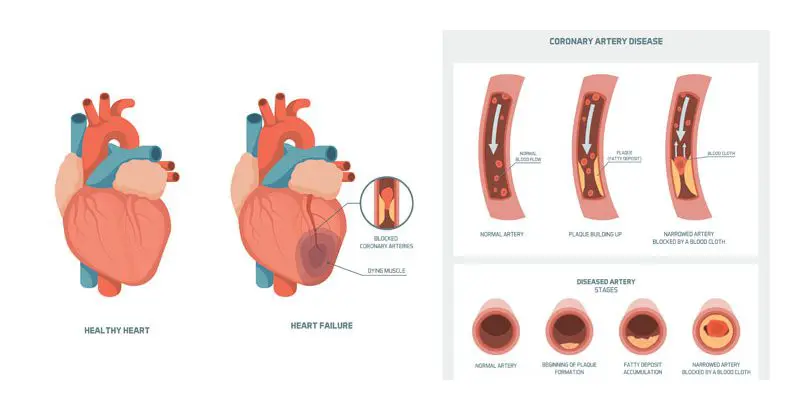 carolina-cardiology-associates-coronary-artery-disease-chart